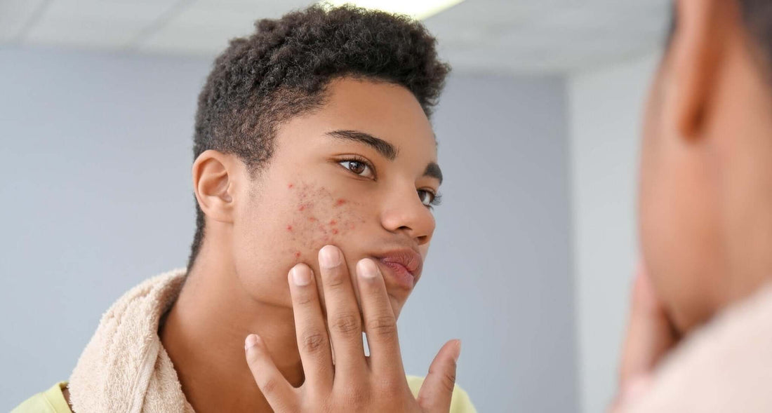 Different Types of Acne and How to Treat Them - Three Ships
